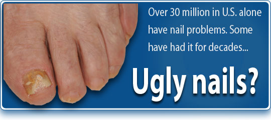 picture of ugly toenail under toenail