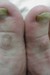 onychomycosis big toes